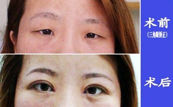 三角眼是怎么形成的？三角眼怎么改善?