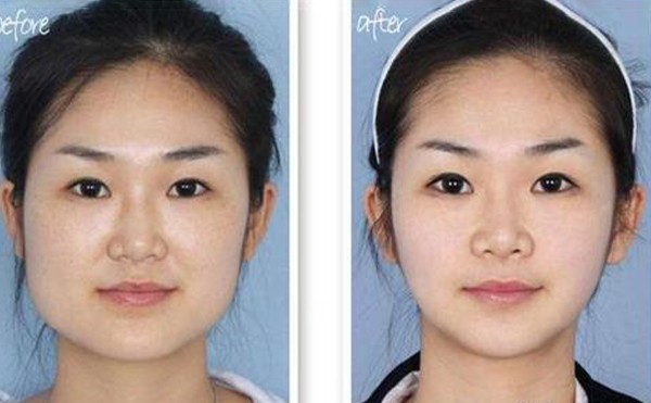 下颌角整形手术步骤有哪些？术后怎么护理？