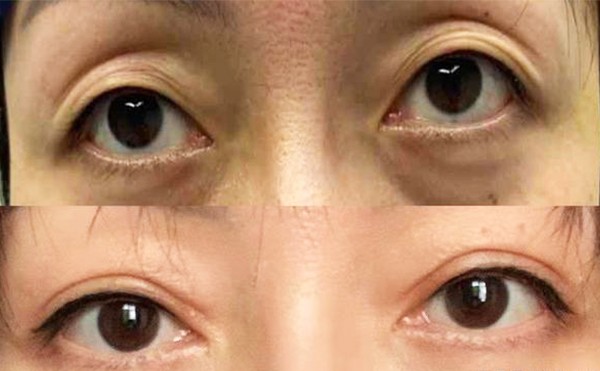 年轻人眼窝凹陷是什么原因？年轻人眼窝凹陷怎样恢复？