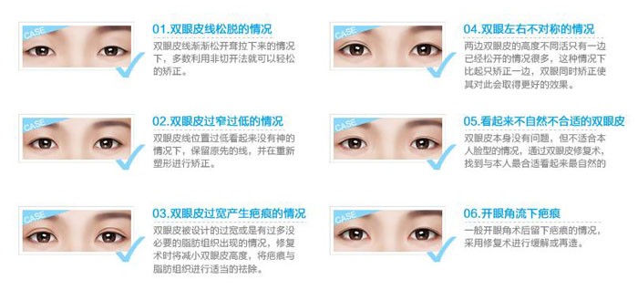 双眼皮修复手术成功率高吗？双眼皮修复的最佳时间