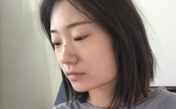 下颌角整形适宜人群有哪些？在沈阳伊美尔做下颌角整形有什么优势？