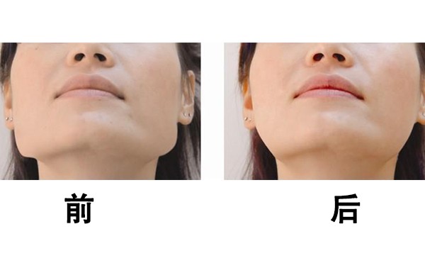 下颌角肥大该怎么办？哈尔滨斯美诺医院做下颌角怎么样？