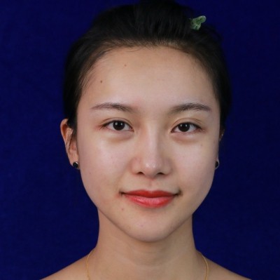 眼综合术前VS术后，自然大眼睛值得称赞！