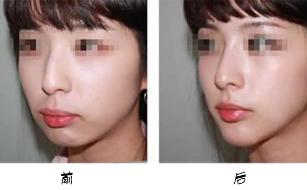 箭鼻的形成原因有哪些？箭鼻矫正手术方法？