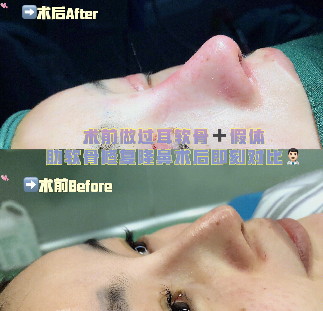 肋骨做鼻子大概多少钱？肋骨隆鼻能维持多久？