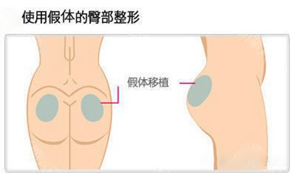 假体丰臀多少钱？假体丰臀是永久性的吗？