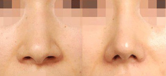 鼻翼缩小术大概多少钱？鼻翼缩小整形安全吗？