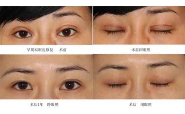 双眼皮怎么样恢复的快？什么人不适合做双眼皮？