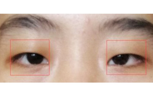 哪些人不能做小眼矫正？矫正术前有什么注意事项？