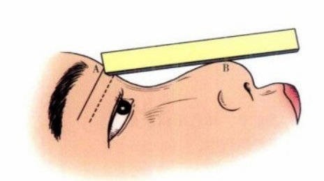 马鞍鼻是什么样子？哪些人需要做鞍鼻矫正手术？
