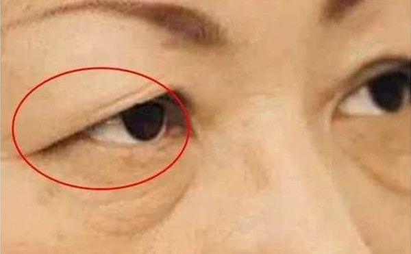 上眼皮松弛是什么原因引起的？上睑松弛怎么办？