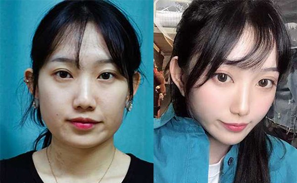 下颌角整容的风险有哪些？下颌角整形多少钱？