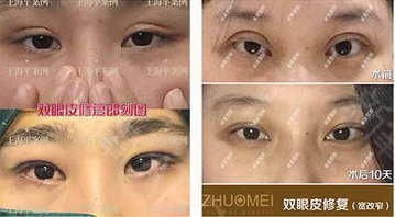 武汉卓美美容医院做双眼皮修复怎么样？双眼皮修复大概多少钱？