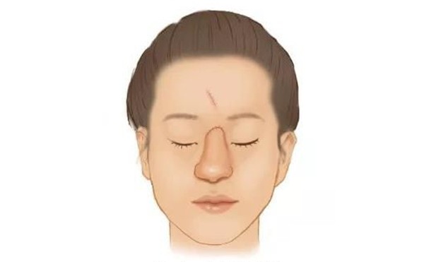 全鼻再造手术的方法是什么？全鼻再造的术后护理怎么做？