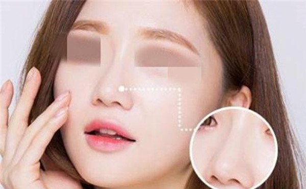 出现什么情况是隆鼻失败？隆鼻失败多久可以重新做？