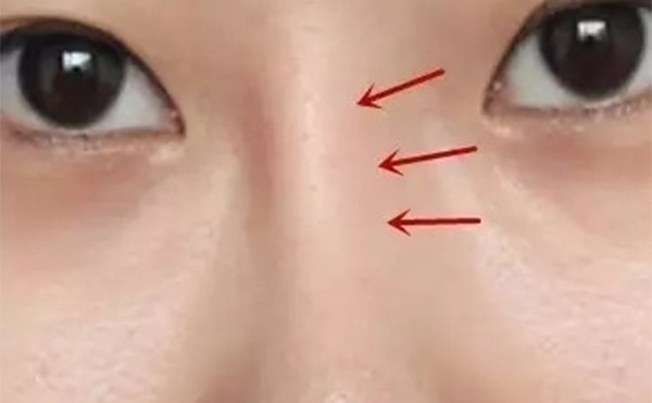 为什么假体隆鼻几年后会变形移位？出现了并发症该怎么办？