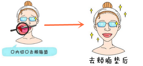 面部吸脂和取颊脂垫有什么区别？哪个效果好？