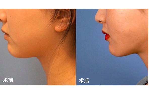 面部吸脂后皮肤会不会松弛？术后怎么护理？