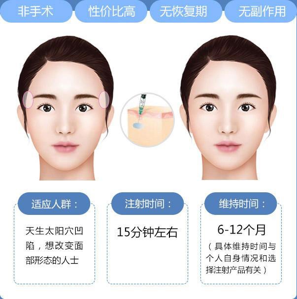 丰太阳穴多少钱？丰太阳穴一般可以维持多久？