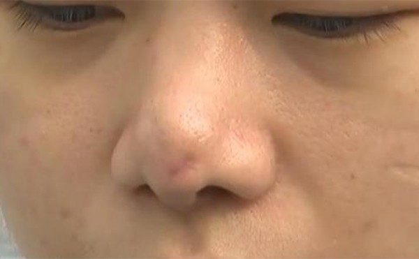 隆鼻假体可以更换吗？假体隆鼻取出能恢复吗？