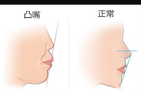 凸嘴矫正需要多少钱？矫正一般要多久？