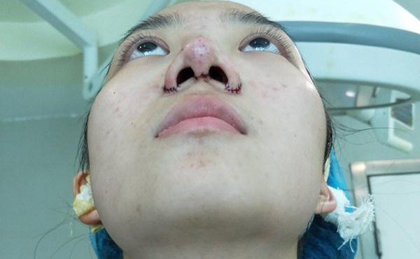 鼻综合是怎么样的？鼻综合一般价格多少钱？