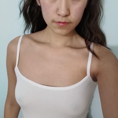 广州韩妃整形美容医院复合丰胸（假体+自体脂肪）100天效果反馈