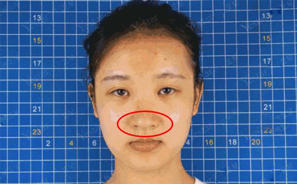 鼻头肥大的原因是什么？鼻头肥大怎么改善？