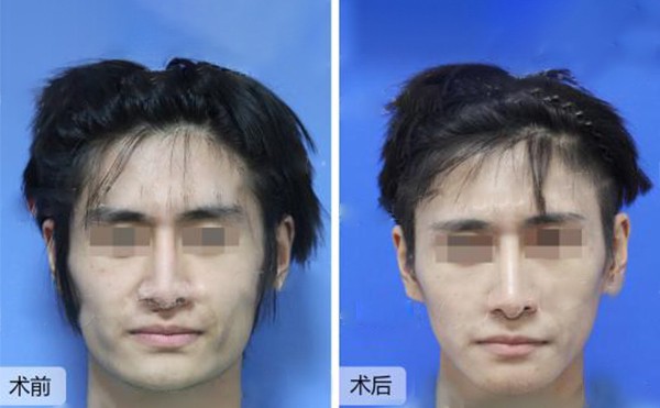 做下颌角整形风险有哪些？下颌角整形多少钱？