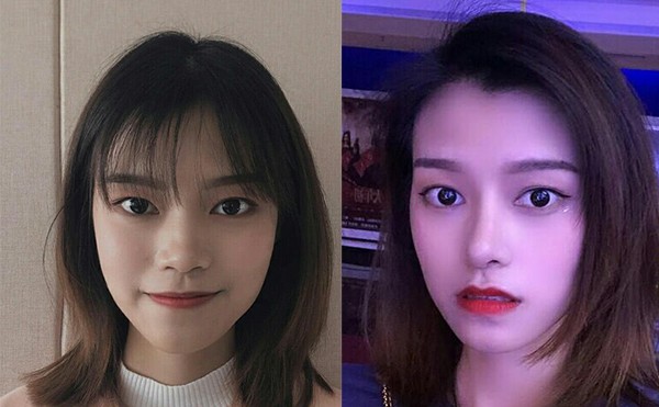 隆鼻术后注意事项有哪些？隆鼻案例分享