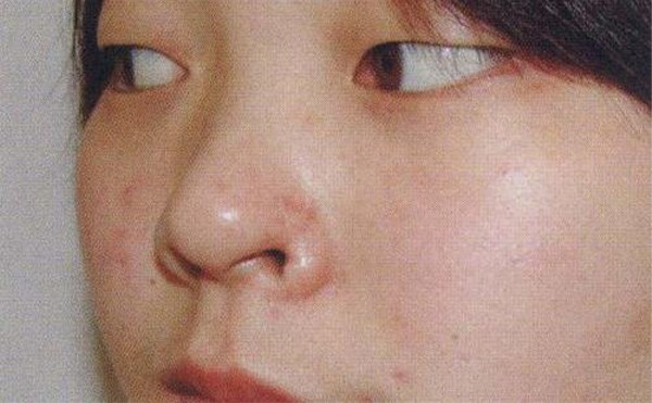 鼻翼缺损怎么补？鼻翼缺损修复需要多少钱？