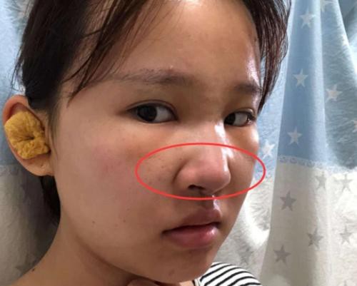 鼻头缩小有什么办法？鼻头缩小手术费用多少钱？