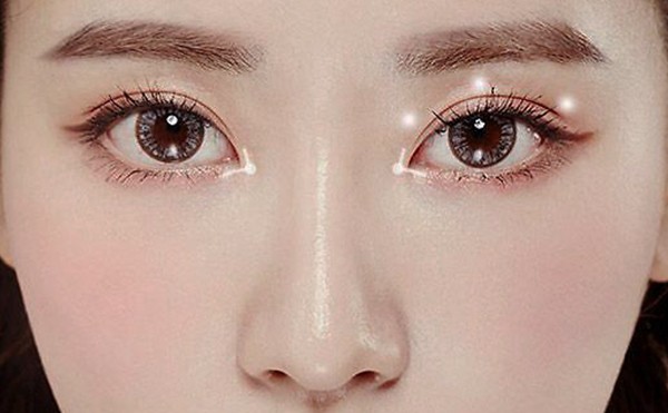 开眼角恢复后会回缩吗？开内眼角多久能恢复好？