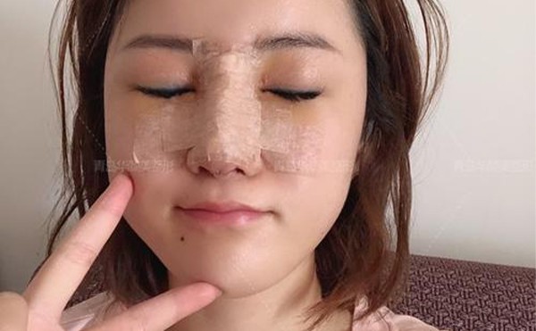 隆鼻失败有哪些表现？隆鼻失败多久能做修复？