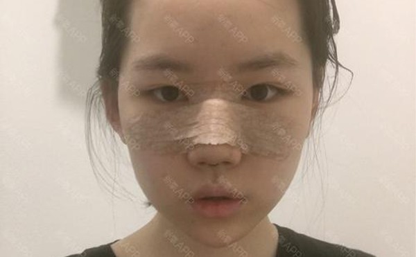 隆鼻需要修复吗？做隆鼻修复手术多少钱？