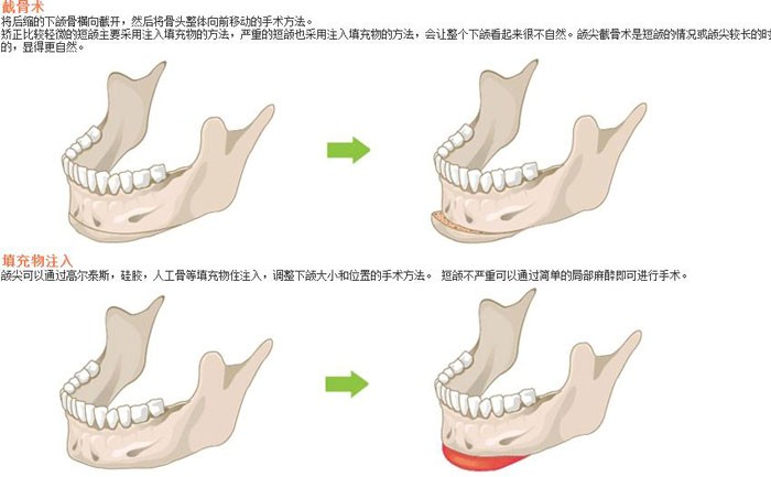 下颌角切除术一般多少钱？下颌角切除有后遗症吗？