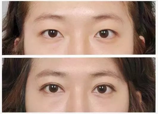 开眼角手术会留疤痕吗？开眼角手术一般多少钱？
