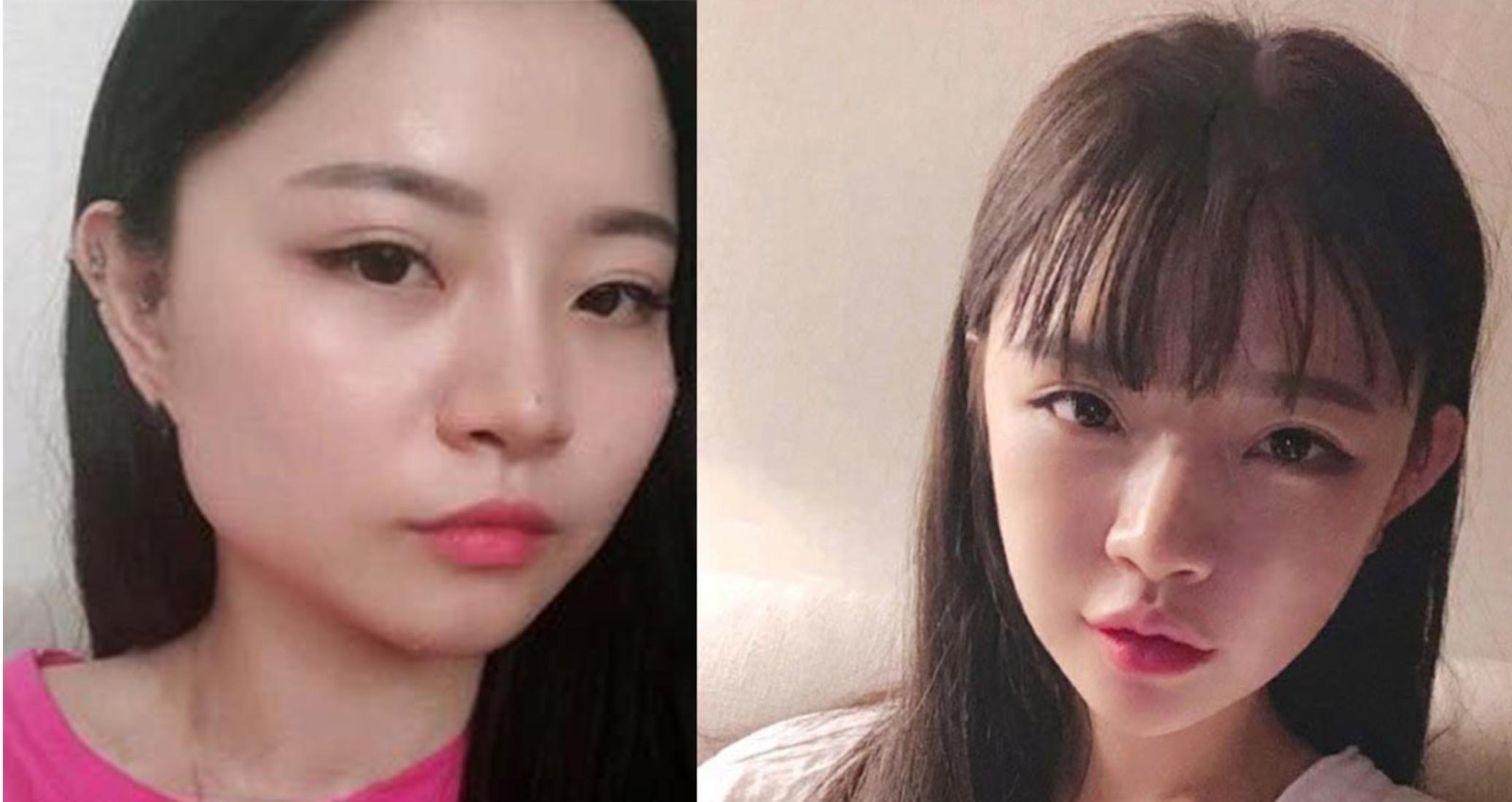 下颌角磨骨手术多少钱？下颌角磨骨手术风险有哪些？