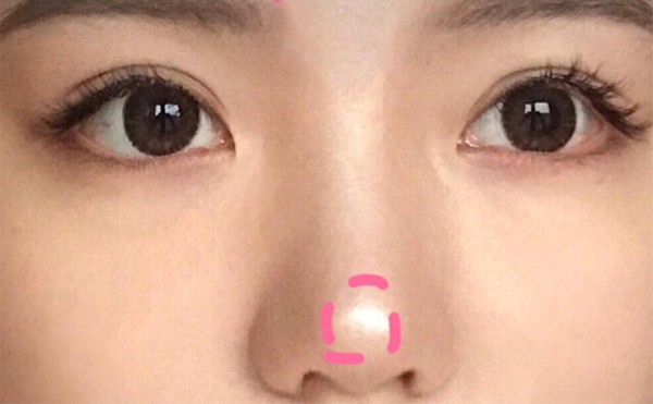 鼻头缩小手术怎么做的？术后应该怎么护理？