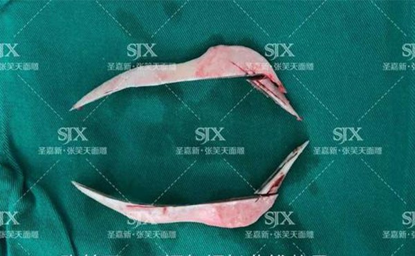 下颌角整形有哪几种方法？下颌角整形手术费用大概多少？