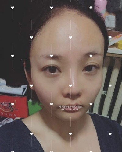呼和浩特诺伊美王艳波自体脂肪全面部填充反馈