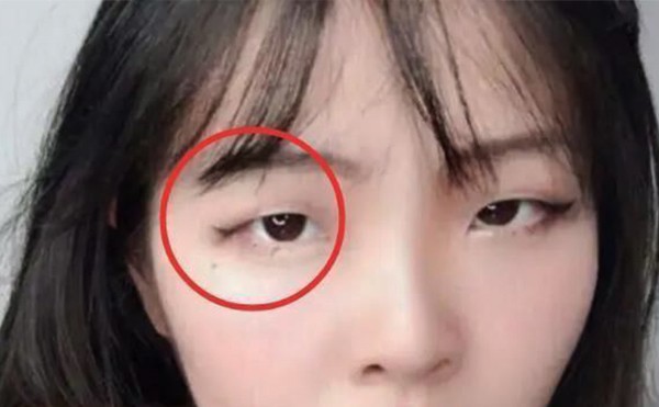 水泡眼是怎么形成的？水泡眼怎么改善？