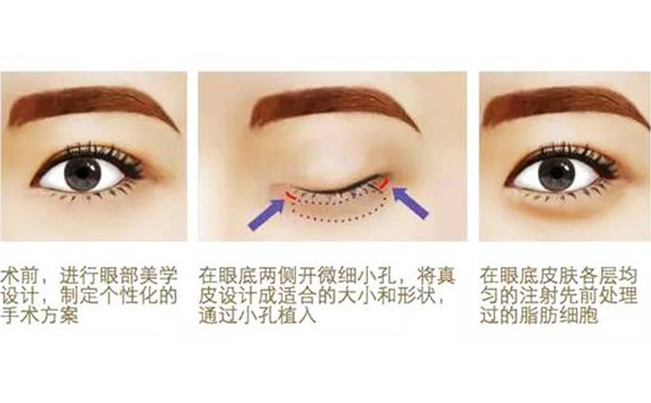自体脂肪丰卧蚕有风险吗？丰卧蚕术后怎么护理？