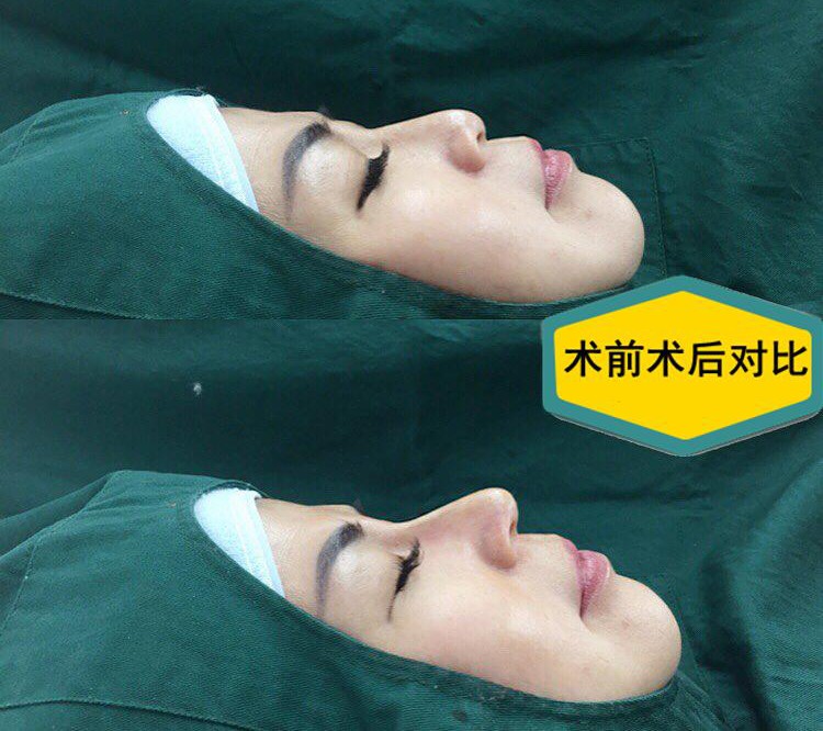 隆鼻手术多少钱左右？隆鼻恢复期要多久？