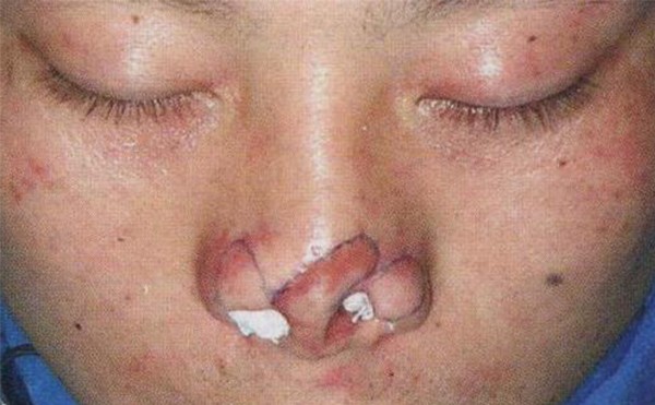 鼻翼缺损怎么办？鼻翼缺损矫正步骤有哪些？