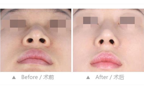 鼻孔缩小整形手术是怎么做的？鼻孔缩小手术一般多少钱？