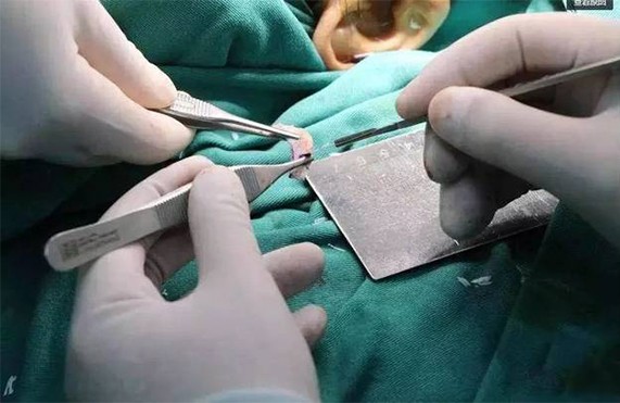 自体软骨隆鼻材料都有哪些？自体软骨隆鼻的优势有哪些？