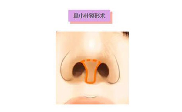 鼻小柱延长手术是什么样的？鼻小柱延长术多少钱？