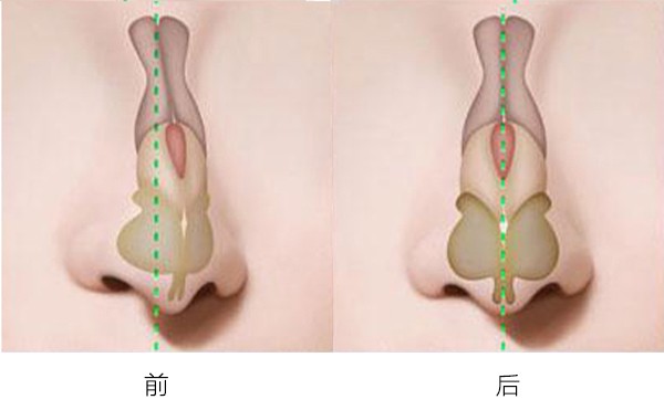 歪鼻整形可以改善什么类型的歪鼻？哪些情况下不允许做歪鼻矫正？
