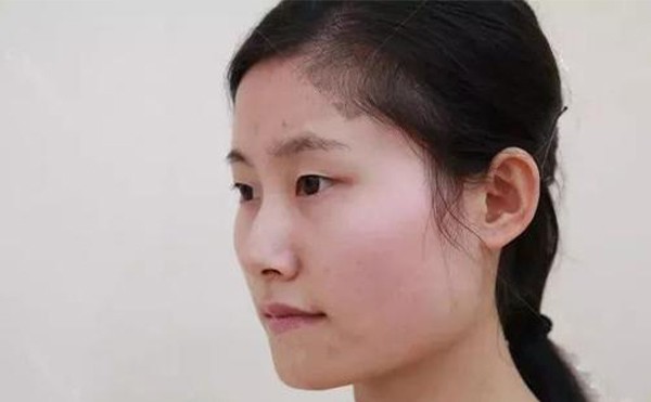 下颌角切除后还会再长吗？哪些人不能做下颌角切除手术？